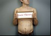 Louis Theroux: Under The Knife